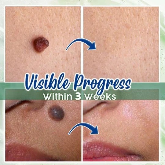 Siero per la rimozione dei nei di ActiveSkin - immagine 2