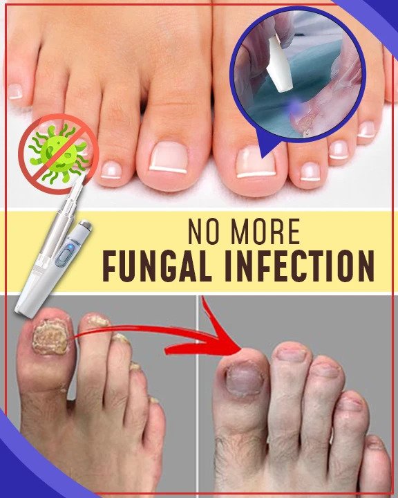 Set per trattamenti antifungini con luce blu - immagine 3