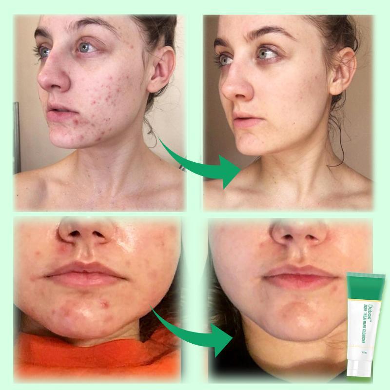 Detergente per il trattamento dell'acne disintossicante - immagine 2