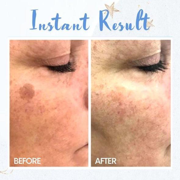 Penna per la rimozione delle macchie - immagine 3