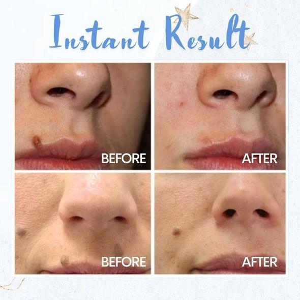 Penna per la rimozione delle macchie - immagine 2